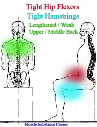 bad posture due to muscle imbalances