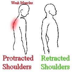 protracted shoulders posture problems